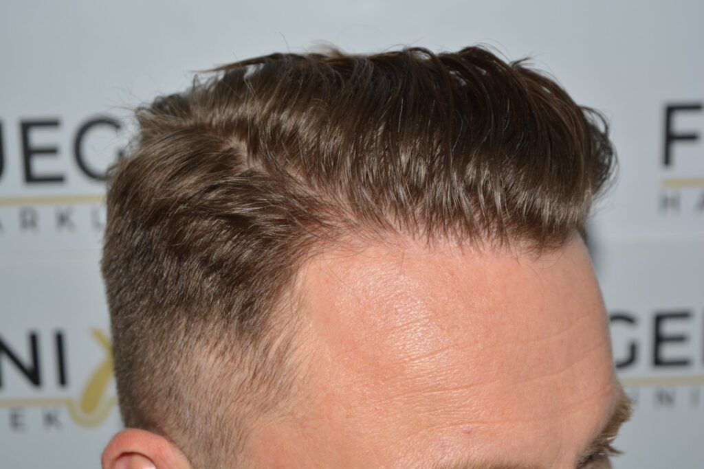 Hairline 18 Months Post Op Result