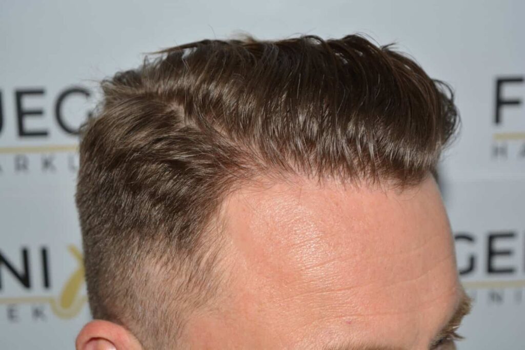 A Perfect Blond Hairline