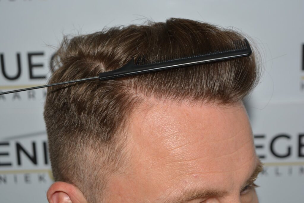 Hairline 18 Months Post Op Result