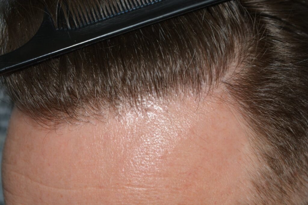 Hairline 18 Months Post Op Result