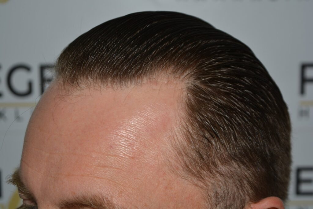 Hairline 18 Months Post Op Result