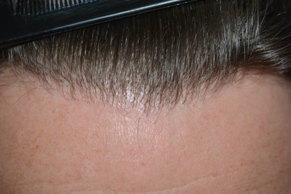 A Perfect Blond Hairline