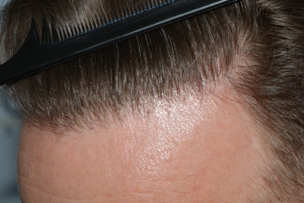 Hairline 18 Months Post Op Result