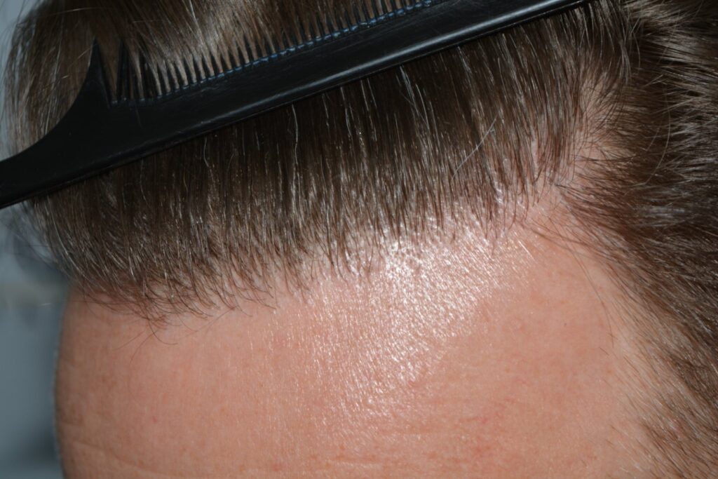 Hairline 18 Months Post Op Result