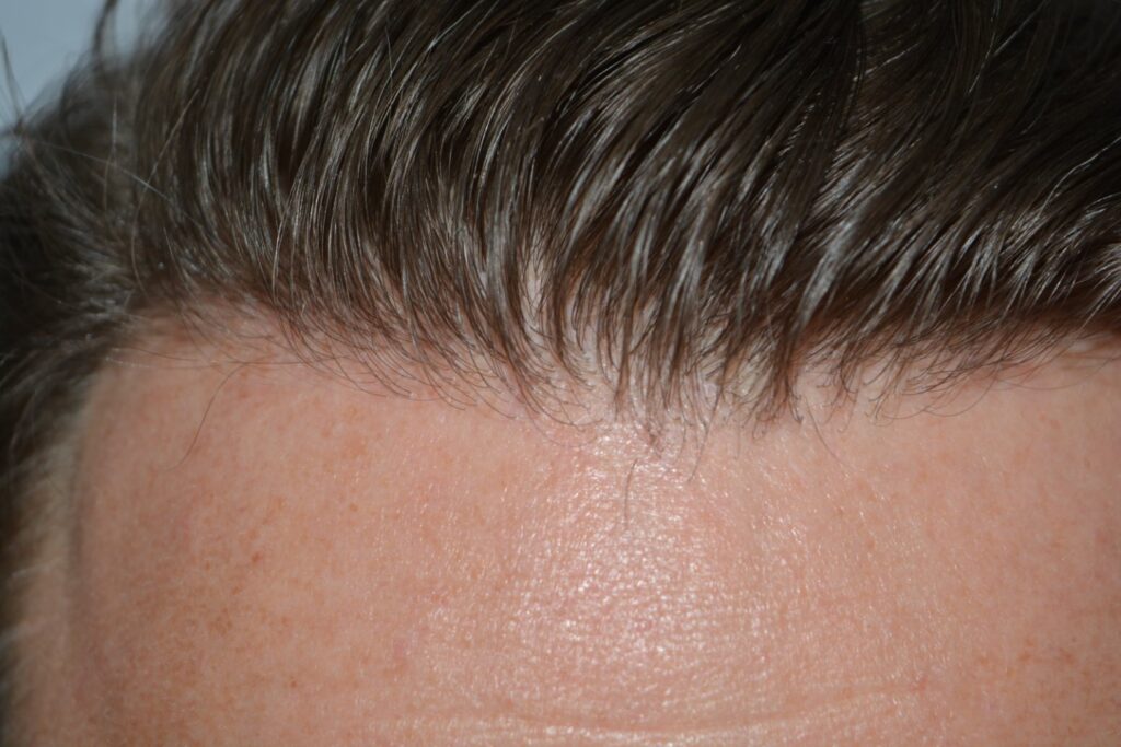Hairline 18 Months Post Op Result