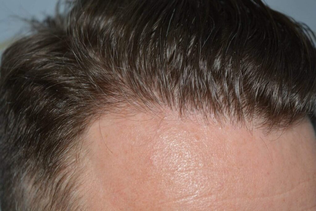 A Perfect Blond Hairline