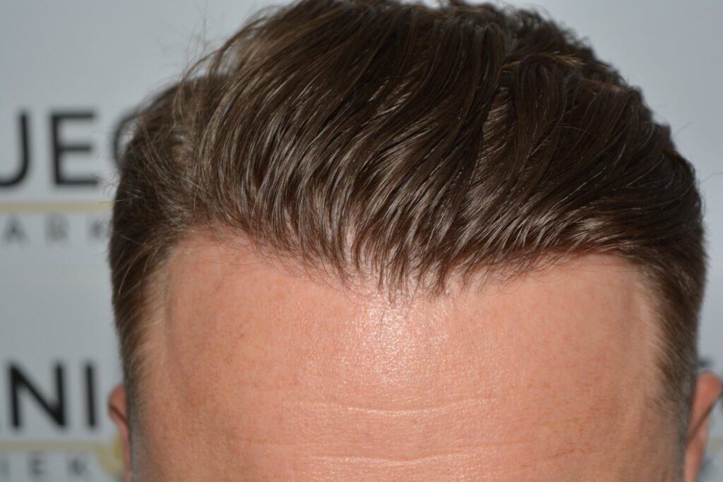 Hairline 18 Months Post Op Result