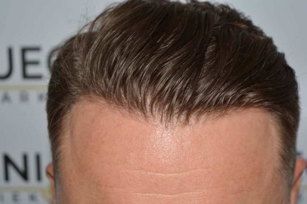 A Perfect Blond Hairline
