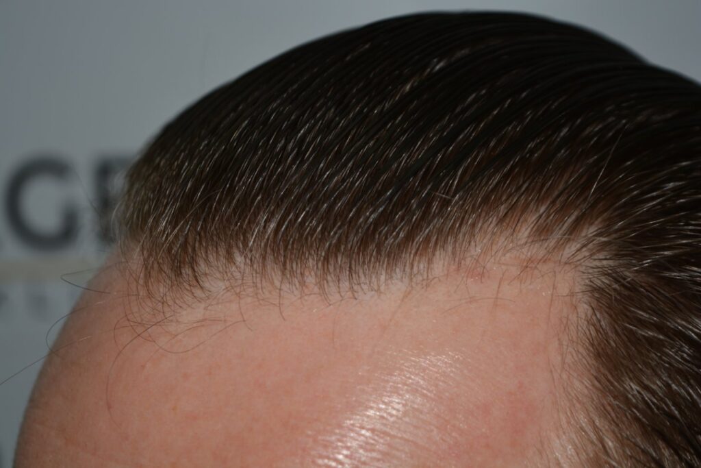 Hairline 18 Months Post Op Result