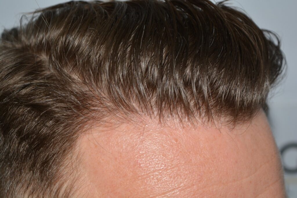 Hairline 18 Months Post Op Result