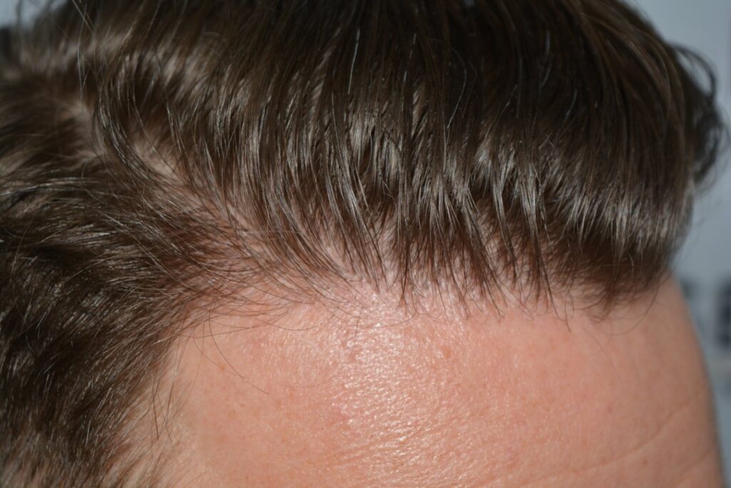 Hairline 18 Months Post Op Result