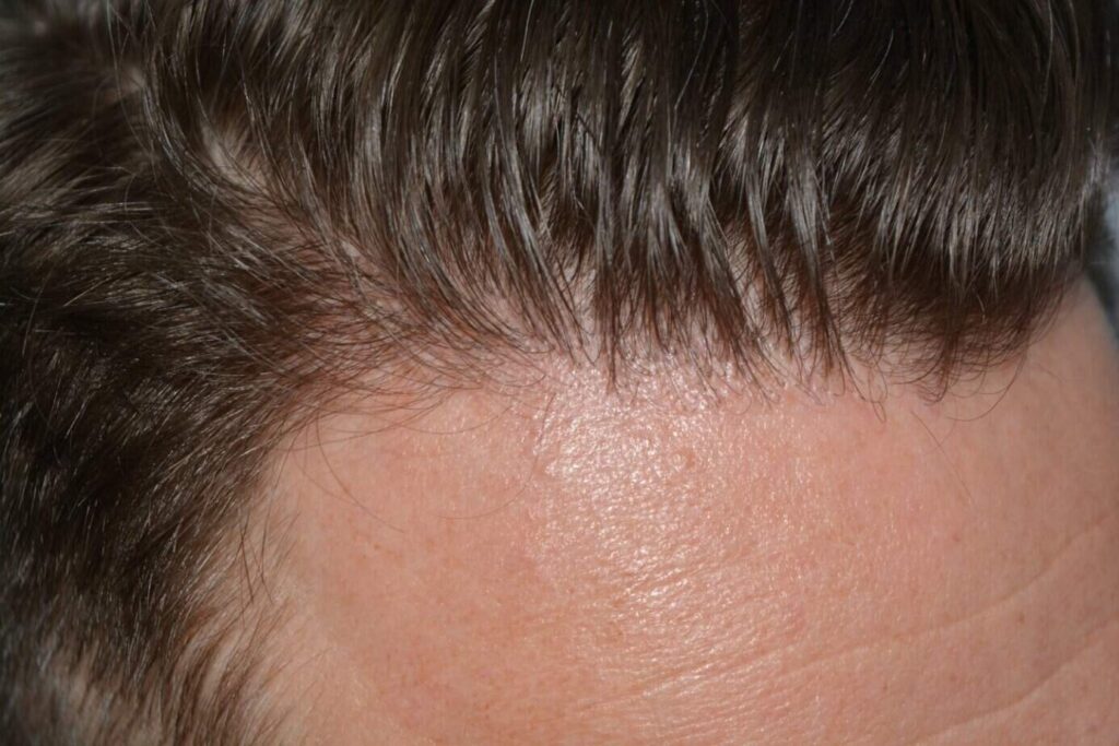 A Perfect Blond Hairline