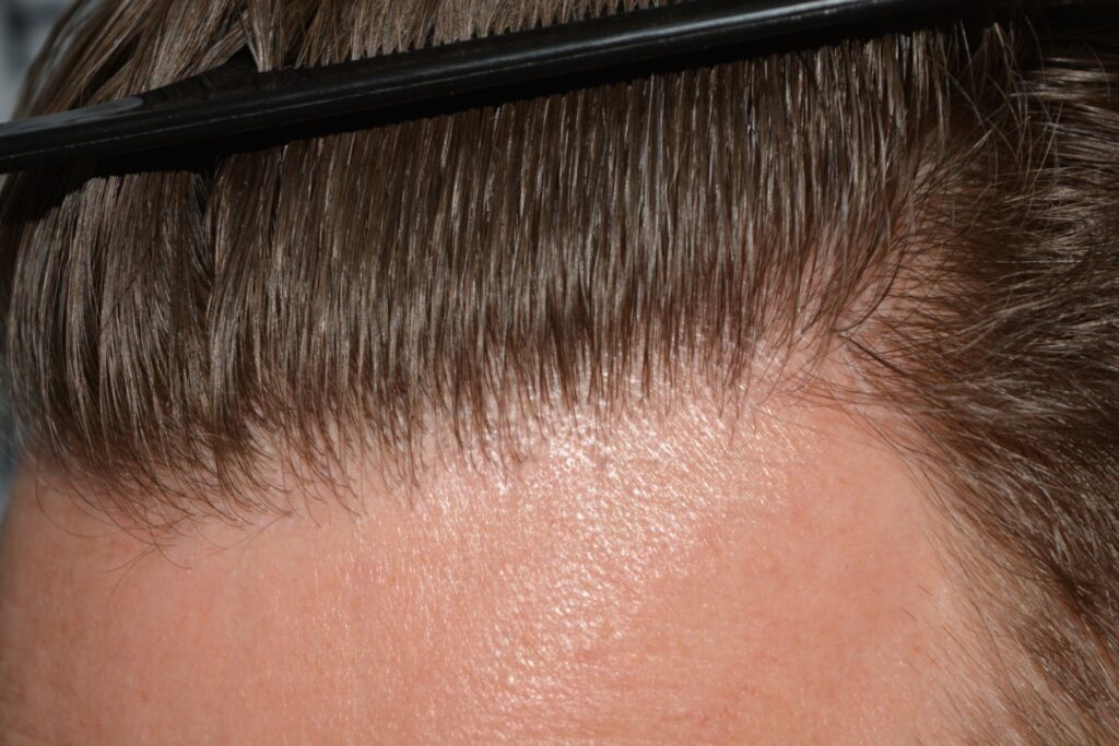 Hairline 18 Months Post Op Result