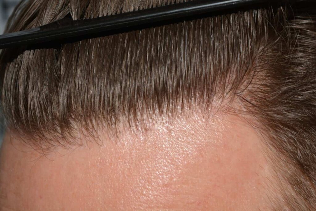 A Perfect Blond Hairline