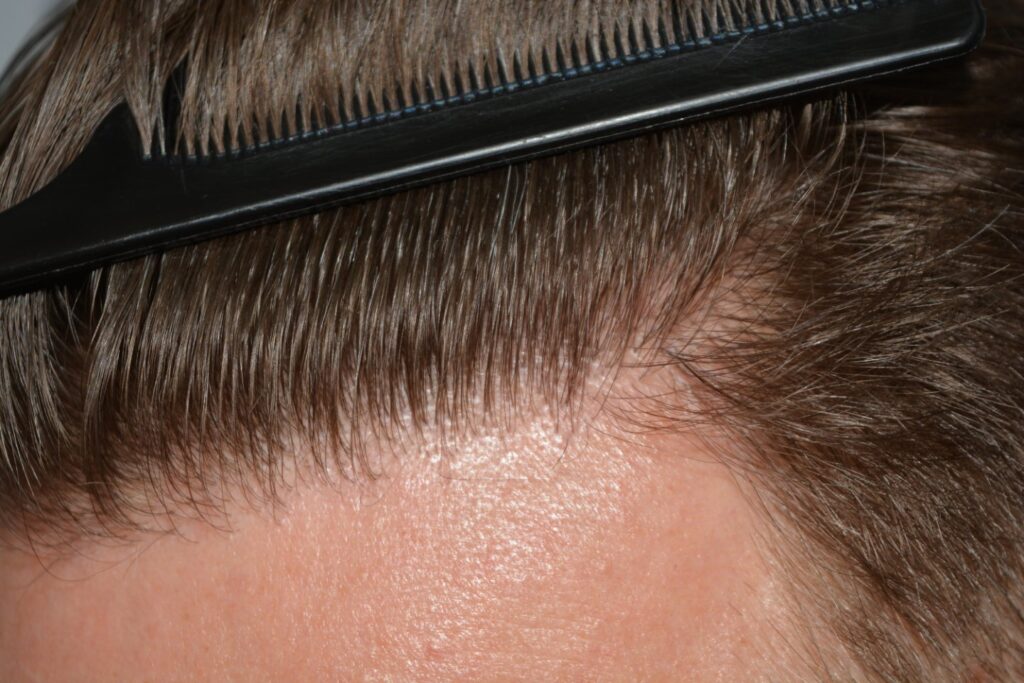 Hairline 18 Months Post Op Result