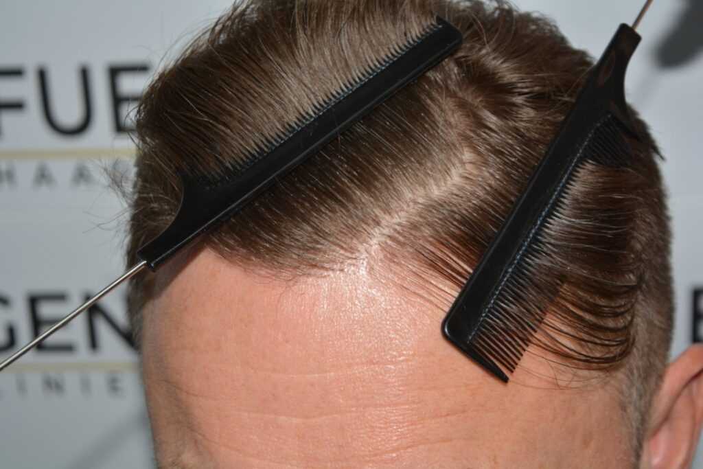 Hairline 18 Months Post Op Result