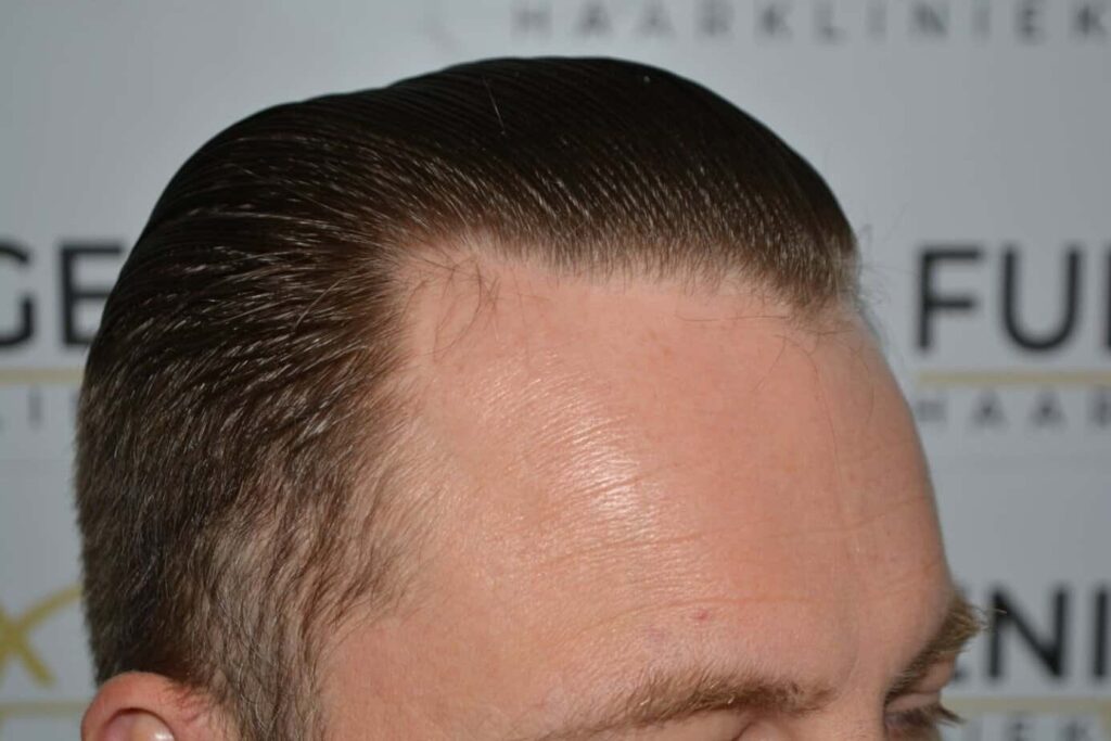 A Perfect Blond Hairline