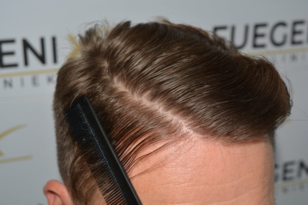 Hairline 18 Months Post Op Result