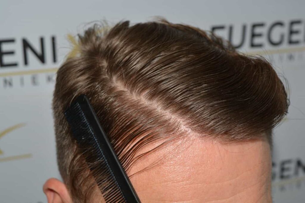 A Perfect Blond Hairline