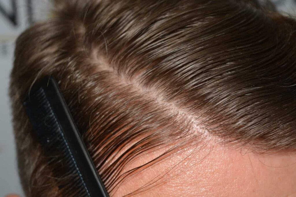 A Perfect Blond Hairline