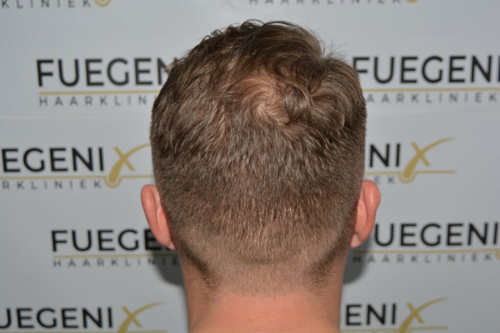 Hairline 18 Months Post Op Result