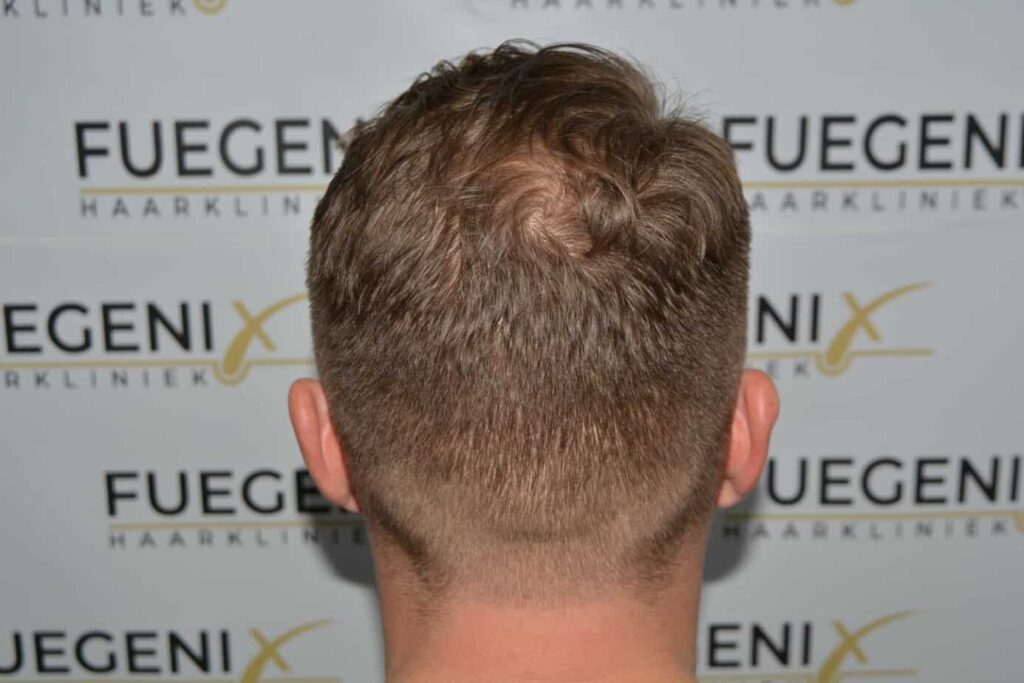 A Perfect Blond Hairline