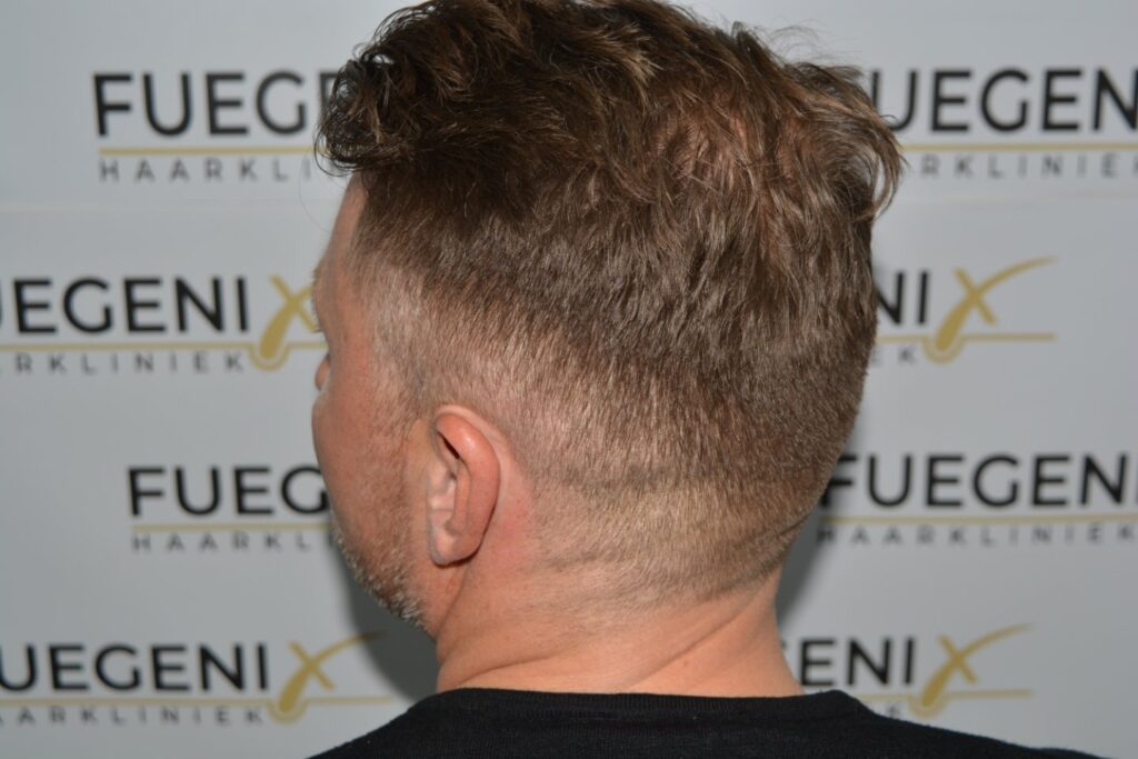 Hairline 18 Months Post Op Result