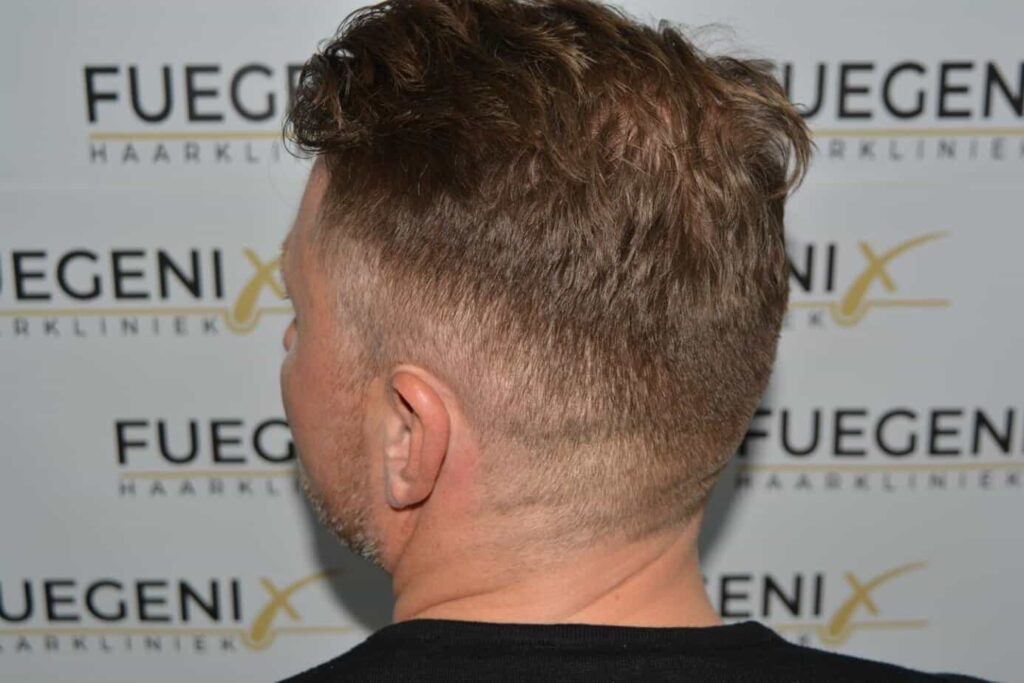 A Perfect Blond Hairline