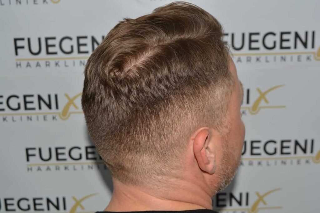 A Perfect Blond Hairline
