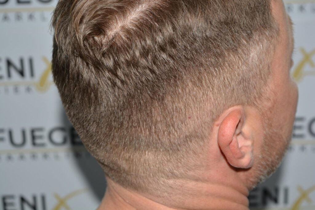 Hairline 18 Months Post Op Result