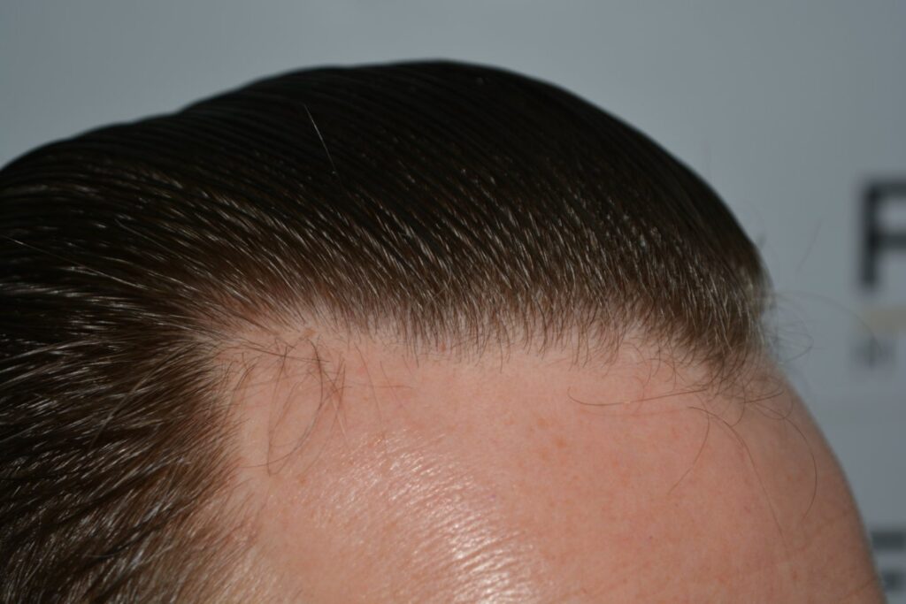 Hairline 18 Months Post Op Result