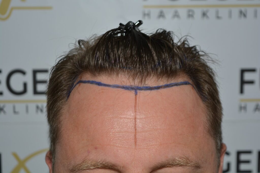 Hairline 18 Months Post Op Result
