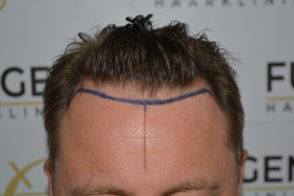 Hairline 18 Months Post Op Result
