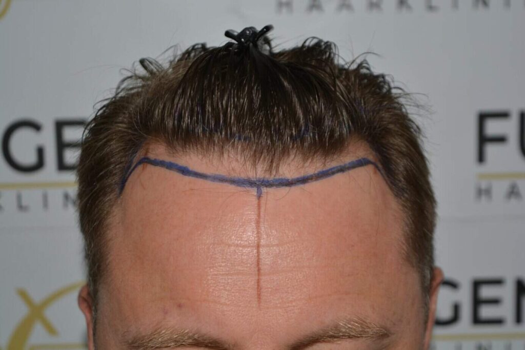 A Perfect Blond Hairline