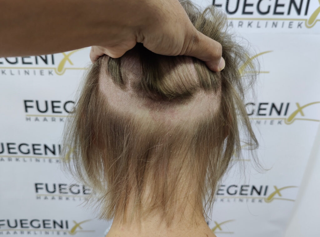 Female Hairline Lowering FUE