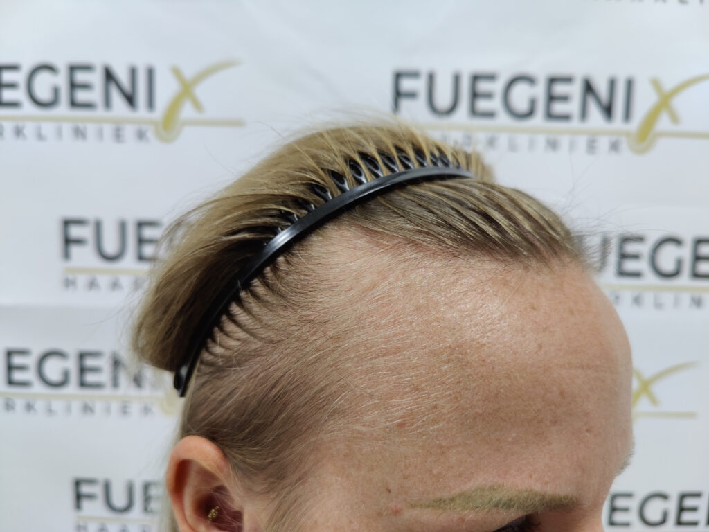 Female Hairline Lowering FUE