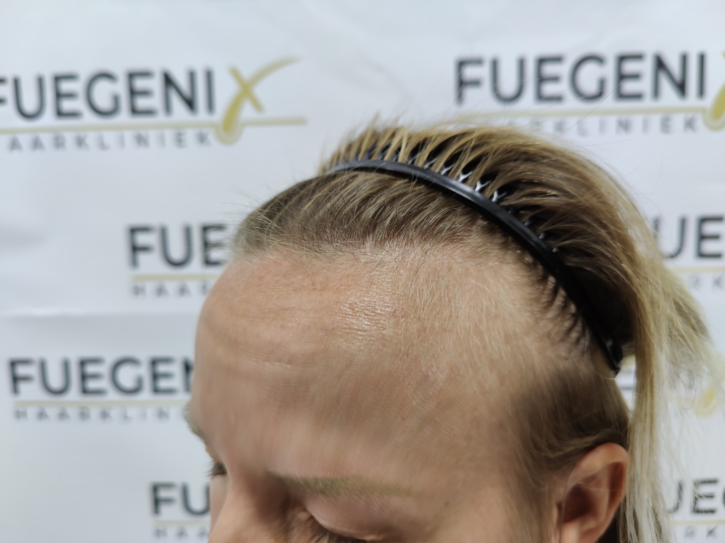 Before – Female Hairline Lowering FUE