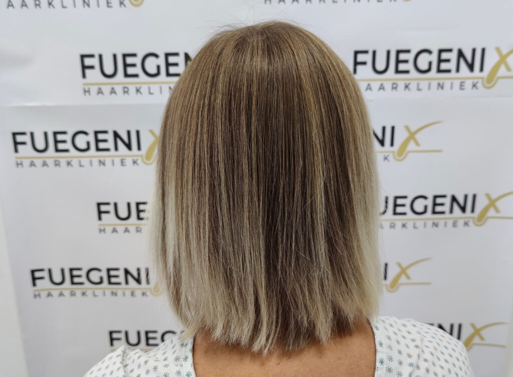 Female Hairline Lowering FUE