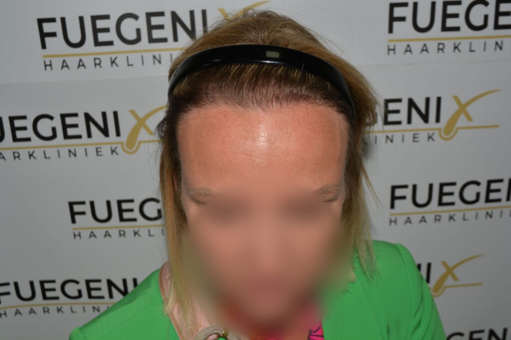 Female Hairline Lowering FUE