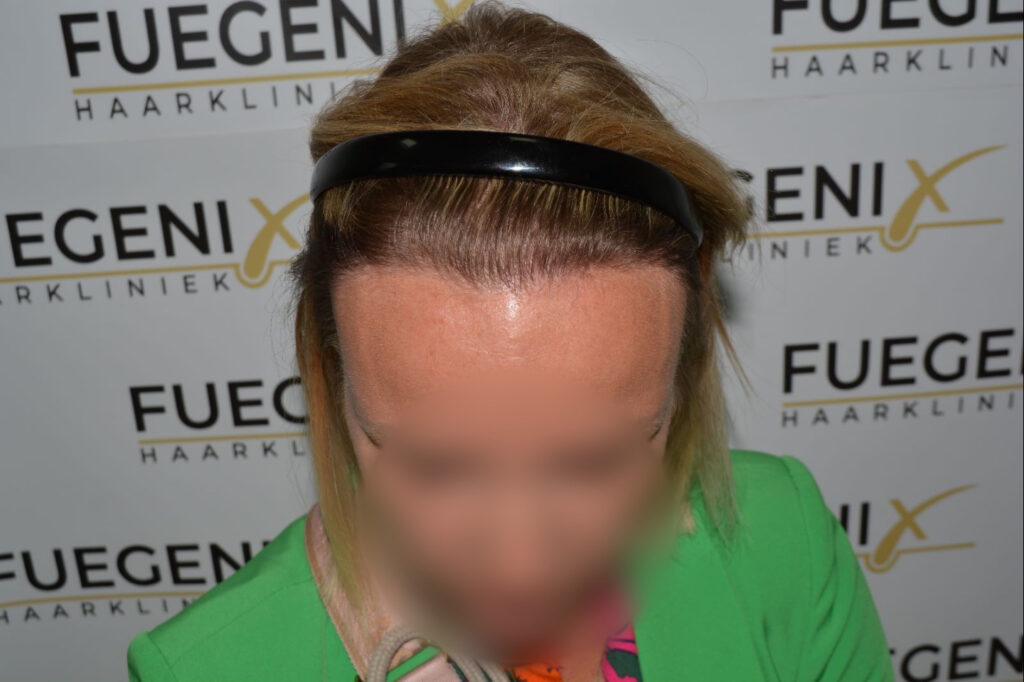 Female Hairline Lowering FUE
