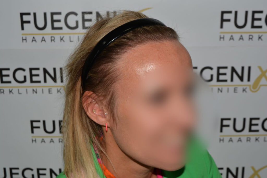 Female Hairline Lowering FUE
