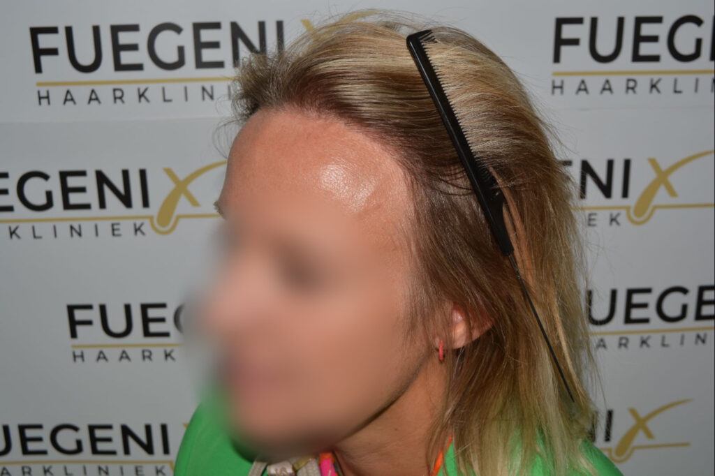 Female Hairline Lowering FUE
