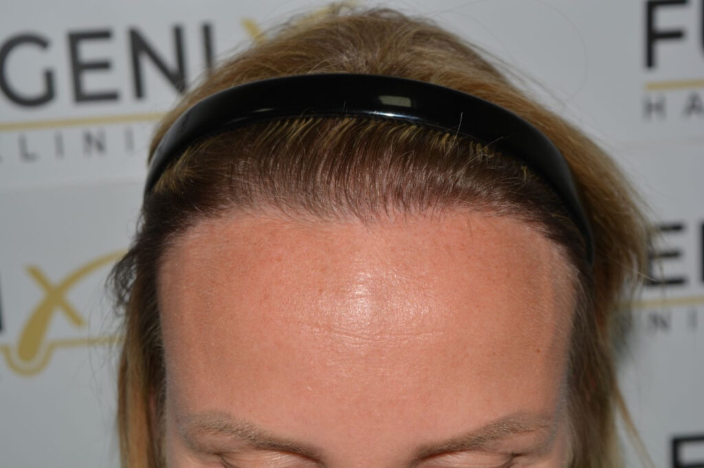 Female Hairline Lowering FUE