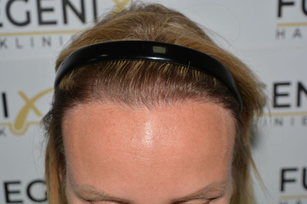 Female Hairline Lowering FUE