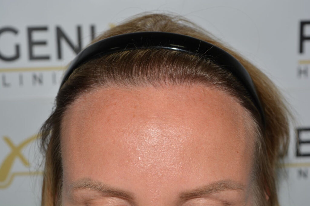 Female Hairline Lowering FUE