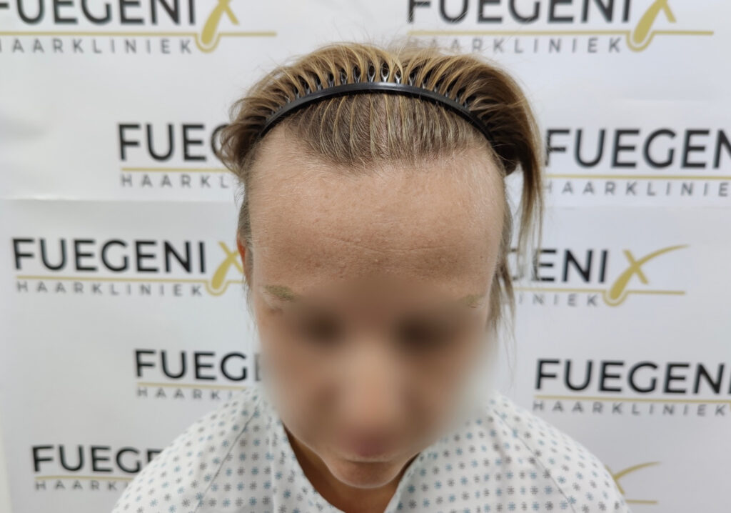 Female Hairline Lowering FUE