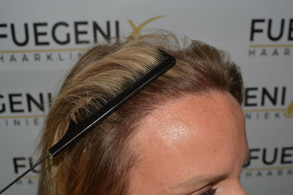 Female Hairline Lowering FUE
