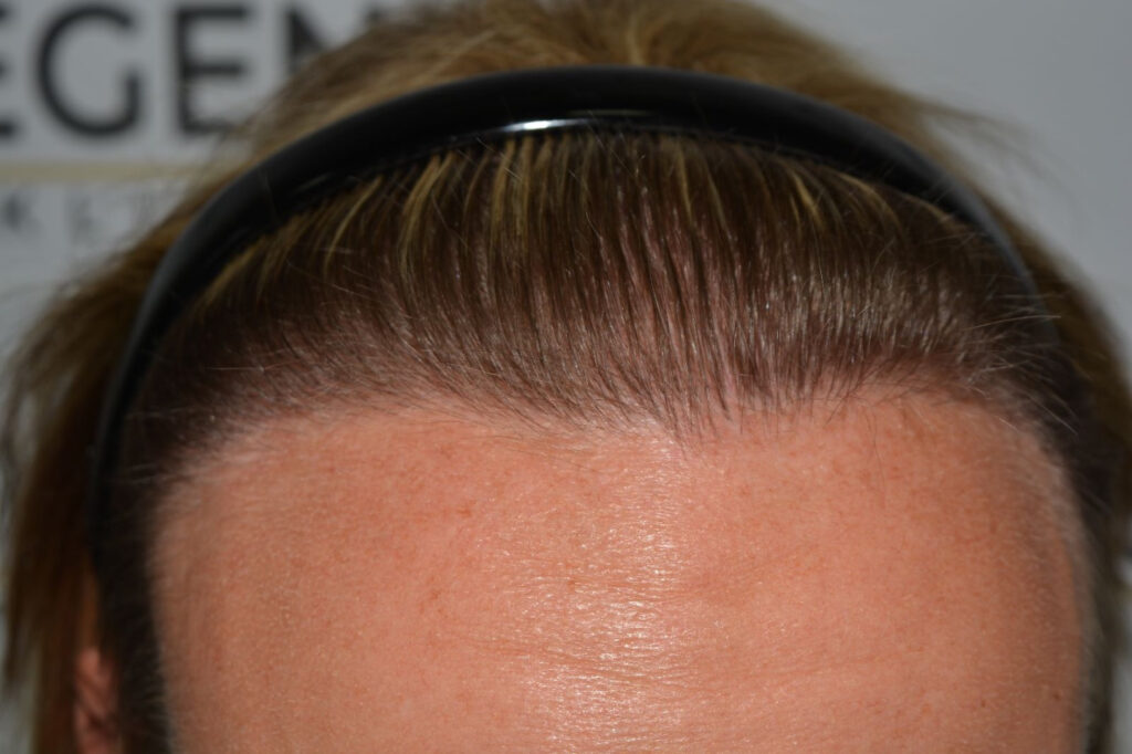 Female Hairline Lowering FUE
