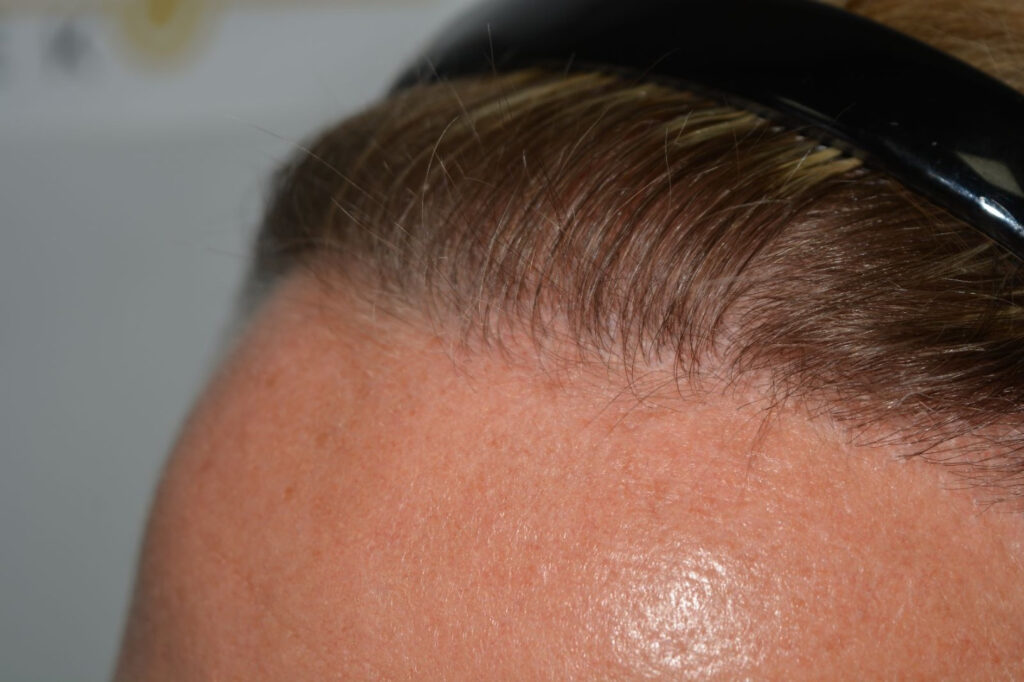 Female Hairline Lowering FUE