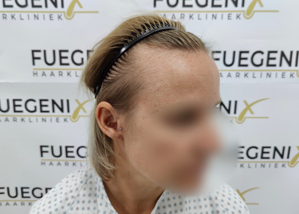 Female Hairline Lowering FUE